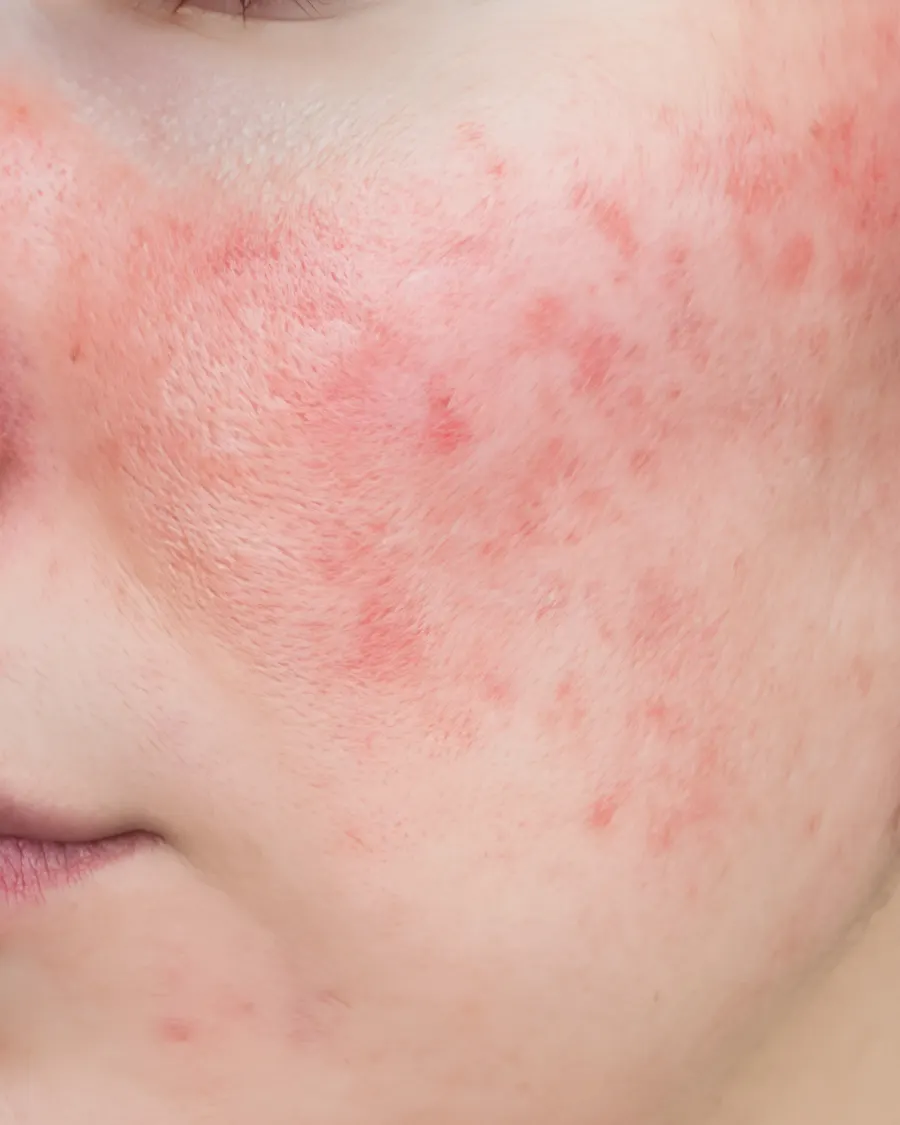 Rosacea at Cinch Clinics